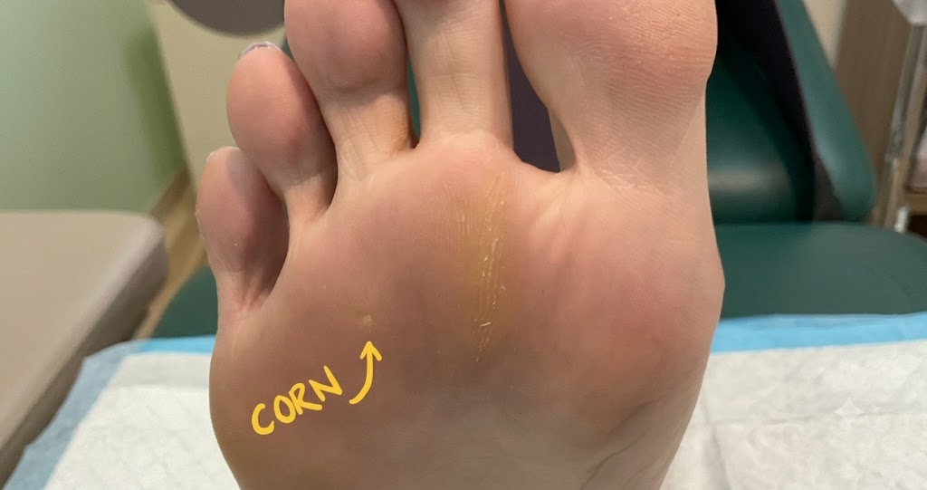 Close-up of the bottom of a patient's foot with a yellow arrow pointing to a small plantar corn, illustrating common foot conditions.
