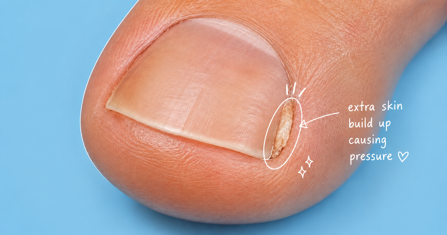 Close-up of a toenail against a blue background with an illustrated white circle highlighting a visible buildup of hard, yellowish skin in the side nail groove. An arrow points to the area with text reading, "extra skin build up causing pressure."