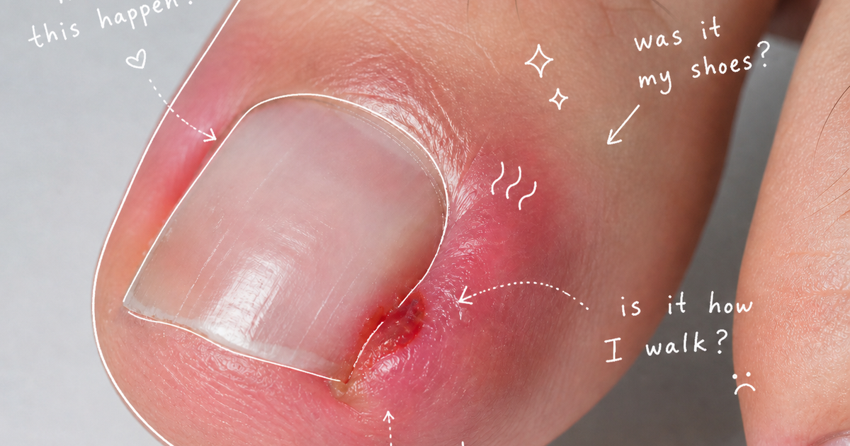 Are Ingrown Toenails Really “Ingrown”?