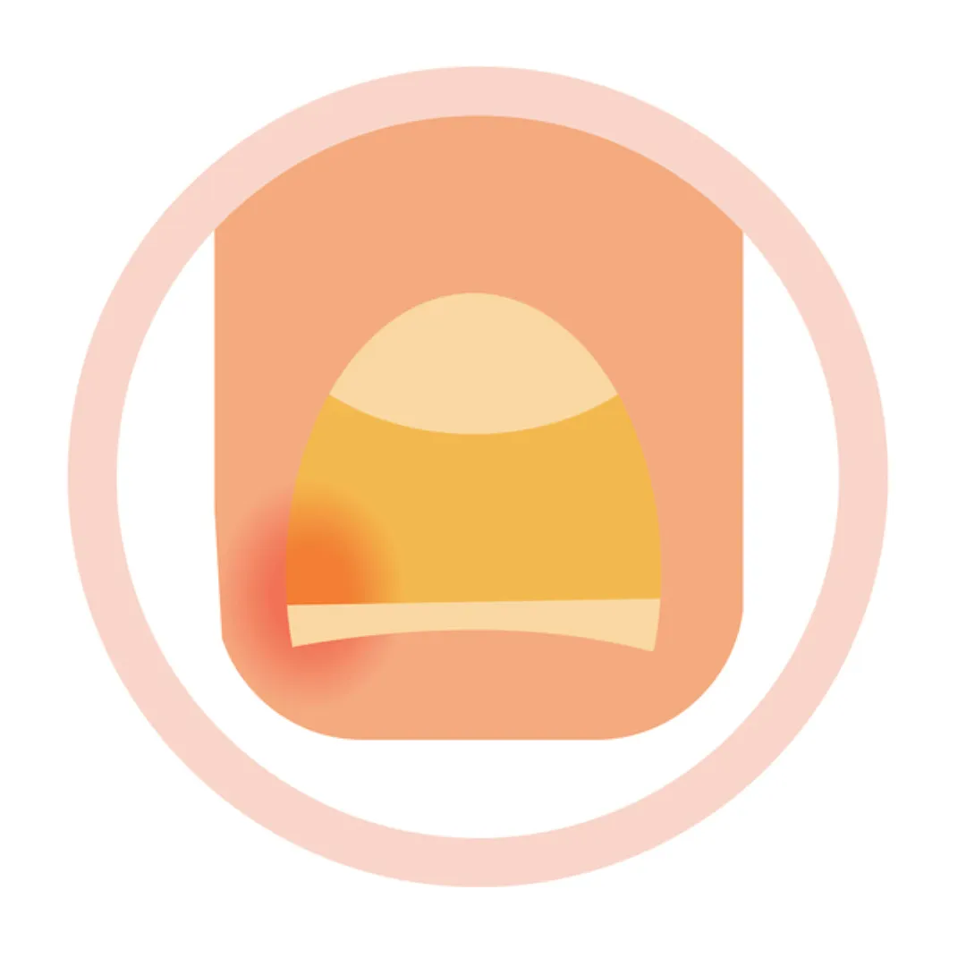 Ingrown Toenail Treatment
