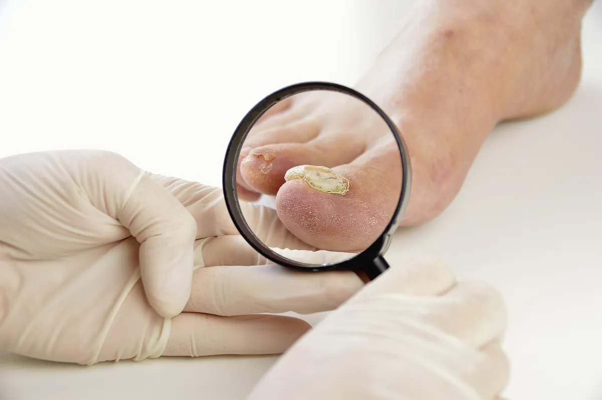 How Do I Know Whether I Have Nail Fungus?