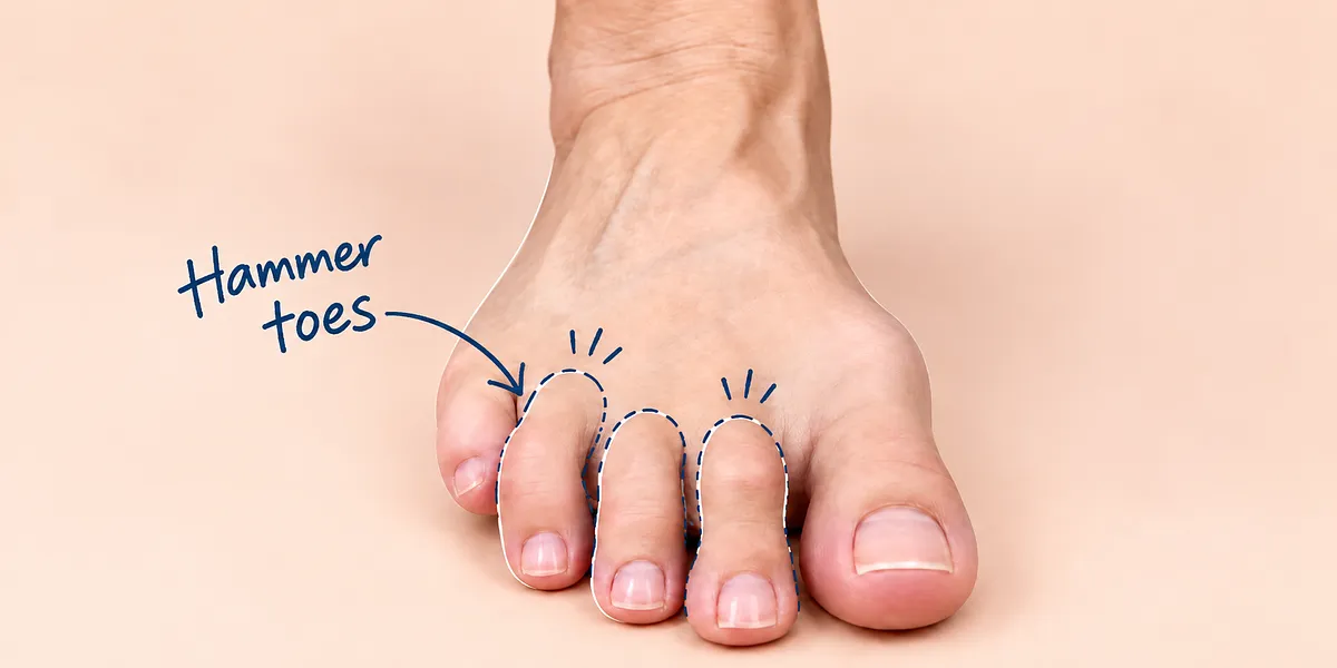 Close-up of a bare foot with hammer toes, highlighted by a navy blue hand-drawn arrow and outline annotations pointing to the curled middle toes on a soft beige background.